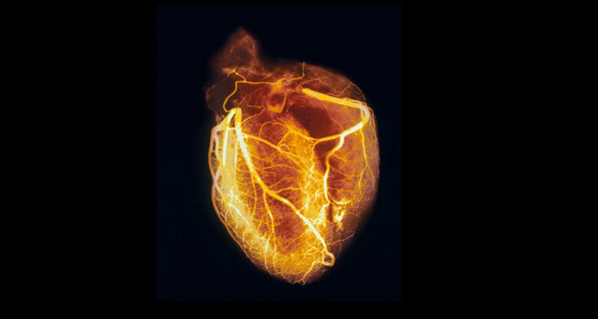 El Misterio De La Muerte Súbita Cardiaca Podría Esconderse En Los Genes